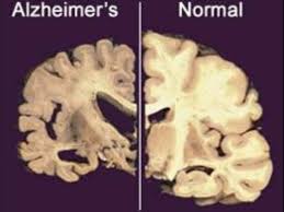 alzheimer